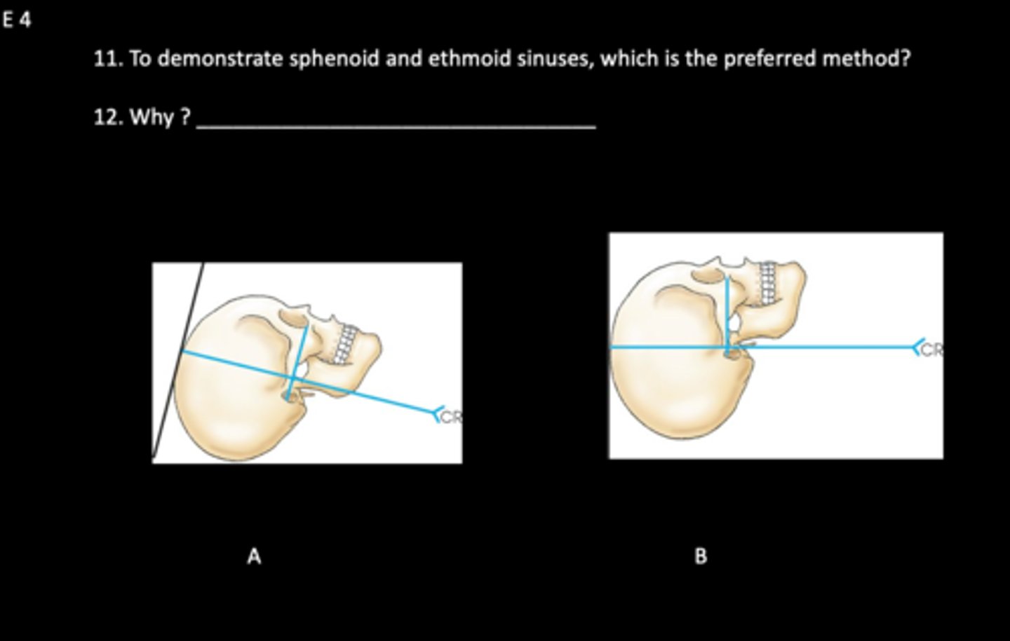 <p>To demonstrate sphenoid and ethmoid sinuses, which is the preferred method, A or B? Why?</p>