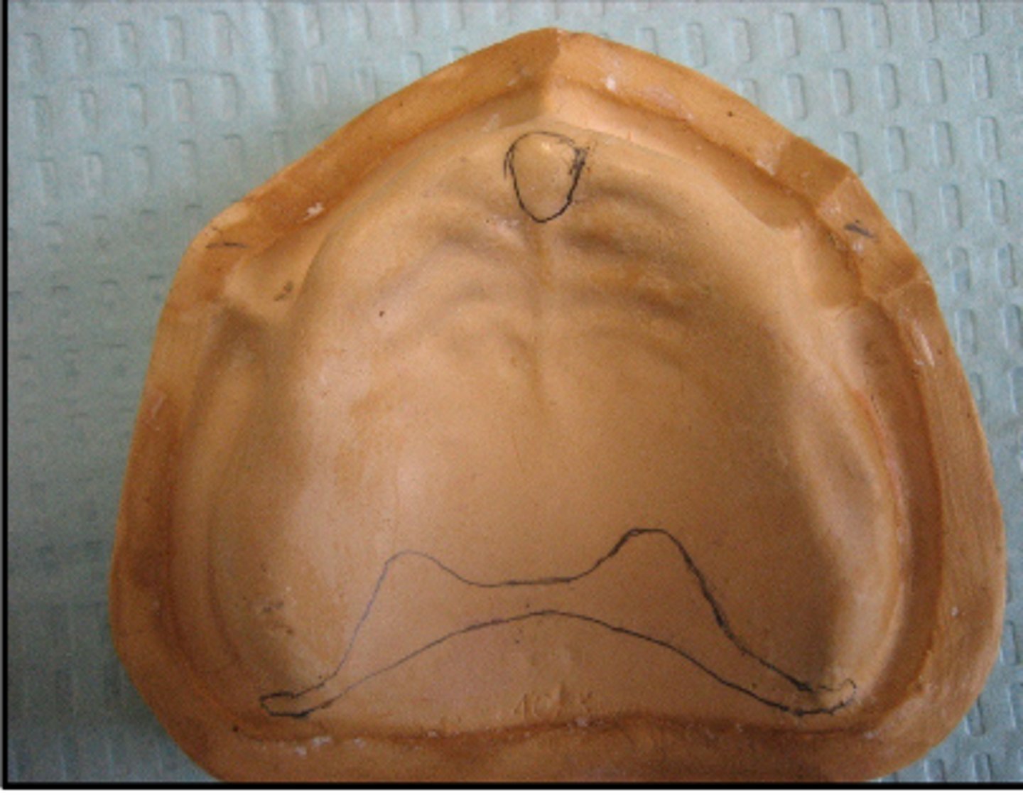 <p>This is what type of residual ridge shape?</p>