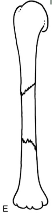 <p><strong>Which fracture?</strong></p>
