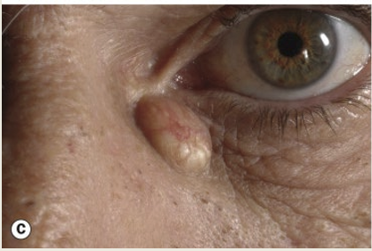 <p>A blocked pilosebaceous follicle that conatins sebaceous secretions. It occurs at the inner canthus. The treatment is observation. </p>