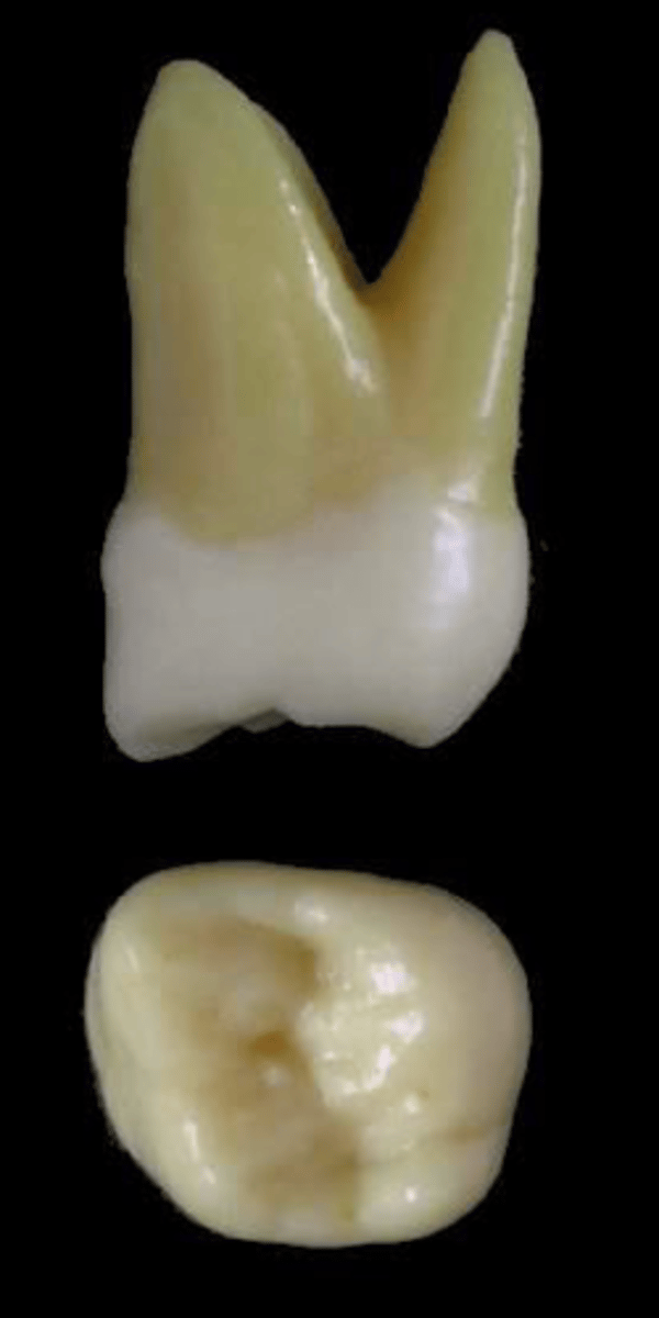 <p>what tooth is this &amp; why?</p>