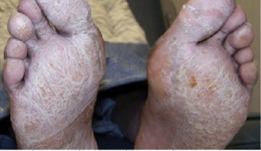 Extremely dry skin