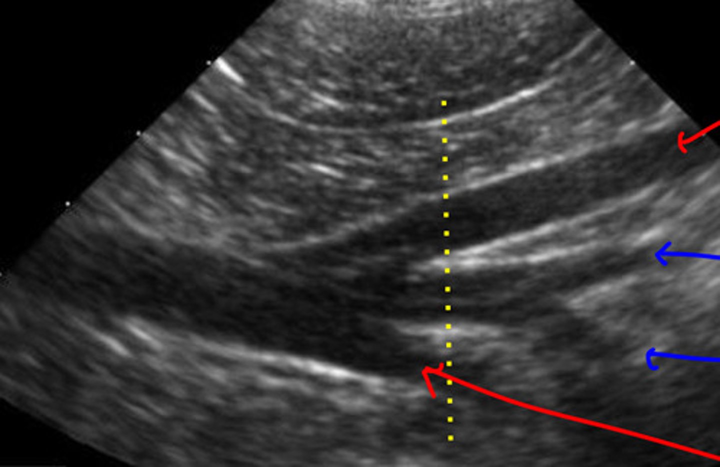 <p>ID red and blue arrows (aortic trifurcation)</p>