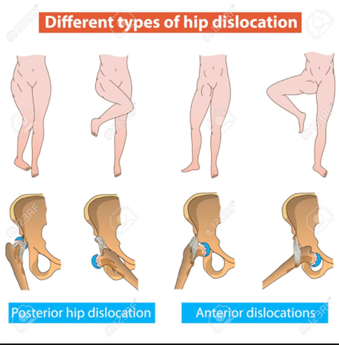 <p>posterior → fem head appears smaller on XR</p>