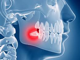 <p>wisdom tooth</p>