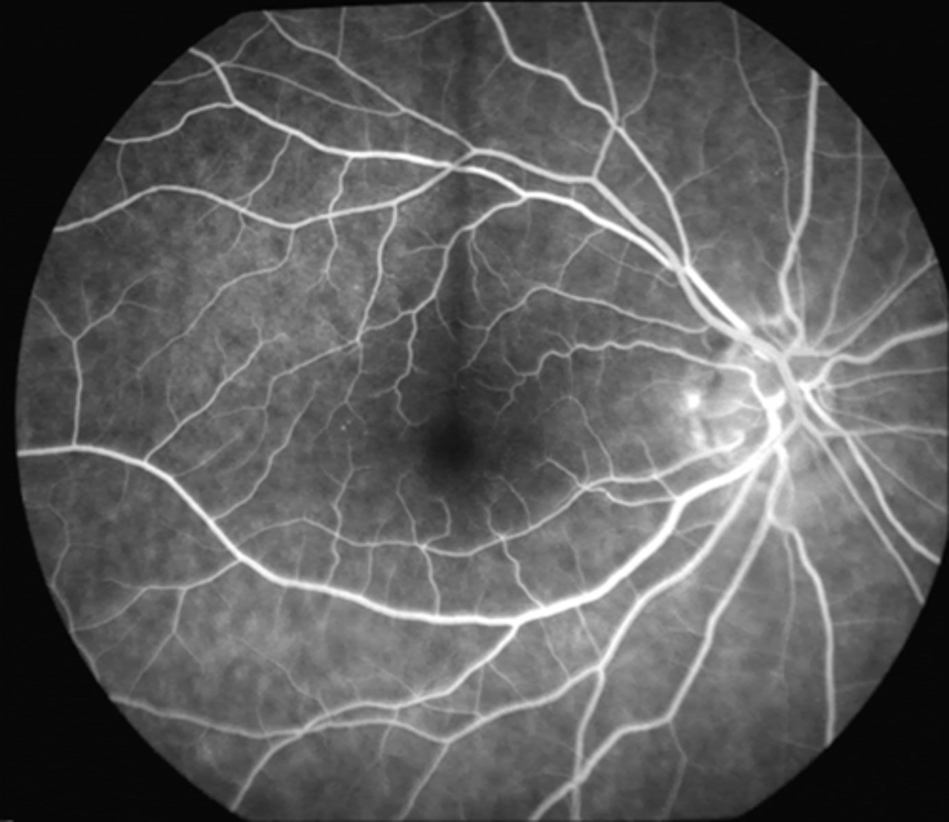 <p>all BV hyperF, including the vein lumen</p><p>ONH hyperF due to capillary perfusion</p>