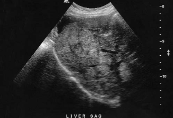 <p><span>A 70-year-old patient presents with elevated alkaline phosphatase, right upper quadrant pain, and rectal bleeding. A sagittal sonogram of the right upper quadrant is documented. Based on this clinical history, the sonographic findings<br>are most consistent with which of the following pathologies?<br></span></p>
