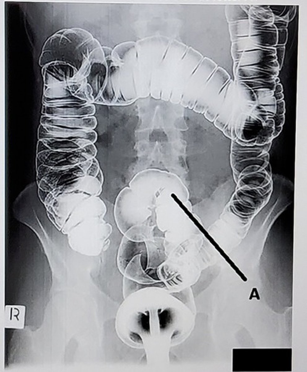 <p>What anatomic structure is labeled as letter A?</p><p>A. Cecum</p><p>B. Rectum</p><p>C. Sigmoid colon</p><p>D. Descending colon</p>