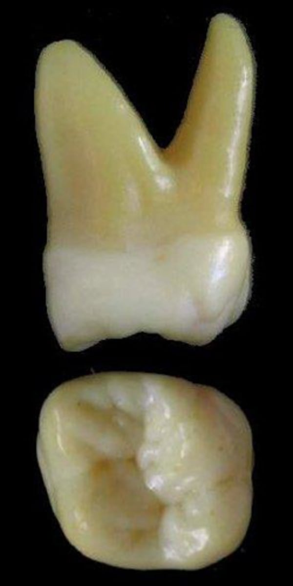 <p>what tooth is this &amp; why?</p>