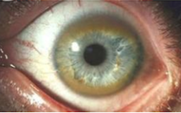 <p>which disease presents with greenish golden crescents on the cornea (<strong>kayser-fleischer rings</strong>) </p>