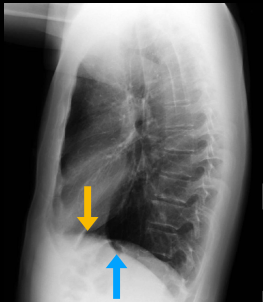 <p>flecha azul— línea del diafragma que se pierde</p>