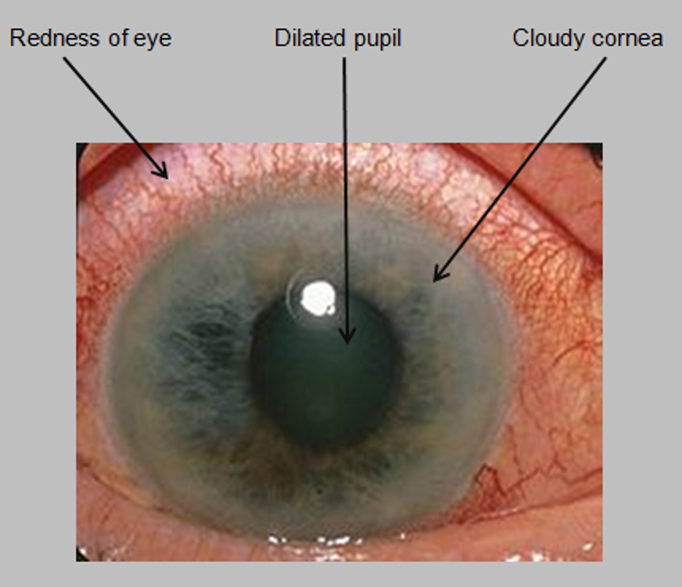 <p>B. Angle-closure glaucoma</p>