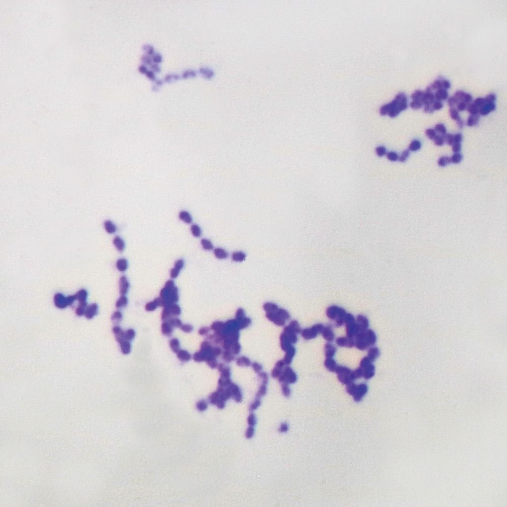 <p><span data-name="test_tube" data-type="emoji">š§Ŗ</span> <strong>Lab differentiation:</strong> Gram stain shows purple lancet-shaped diplococci. Colonies on blood agar are alpha-hemolytic and mucoid due to capsule. Optochin-sensitive, bile soluble.</p><p><span data-name="woman_health_worker" data-type="emoji">š©āā</span> <strong>Patient scenario:</strong> An elderly man develops fever, cough, and rusty sputum. Blood agar shows alpha-hemolytic mucoid colonies. Gram stain shows lancet diplococci.</p><p>(A) Classification: Gram-positive diplococcus.<br>(B) Disease: Pneumonia, meningitis, otitis media.<br>(C) Identification/Diagnosis: Gram stain, alpha-hemolysis, optochin sensitivity, antigen detection.<br>(D) Treatment/Prevention: Penicillin (if susceptible), ceftriaxone. Vaccine available (PCV13, PPSV23).<br>(E) Unique Epidemiology & Lab Safety: Leading cause of bacterial pneumonia. Capsule = major virulence factor.</p>