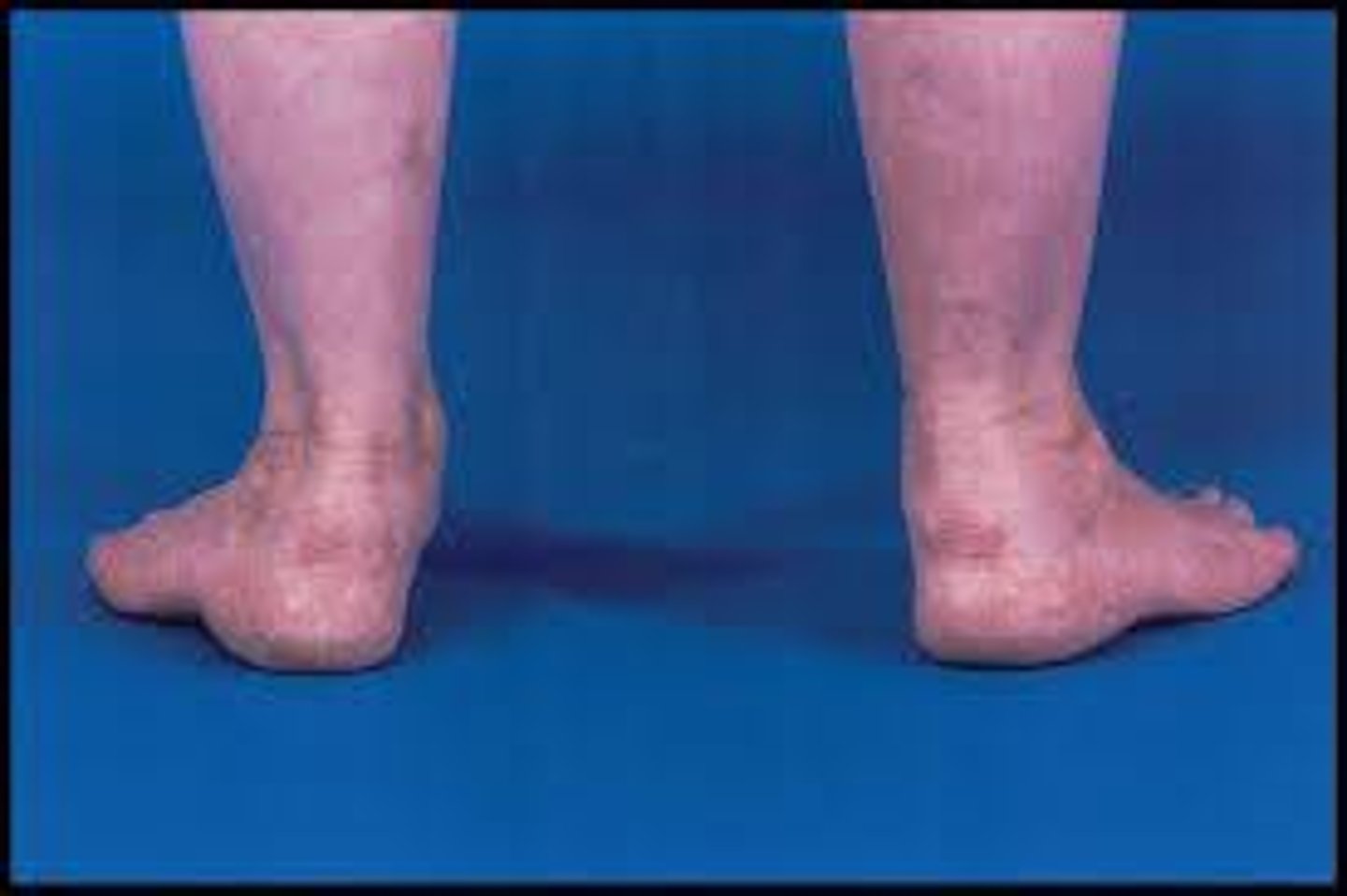 <p>Hindfoot valgus and forefoot abduction</p>