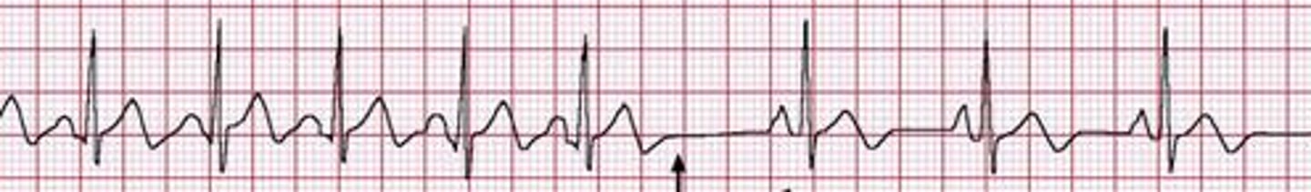 <p>Originates in an atrial automaticity focus (rate 60-80 bpm); p waves are not identical to the previous p waves (because those were produced by the SA node, these are produced by an automaticity focus)</p>