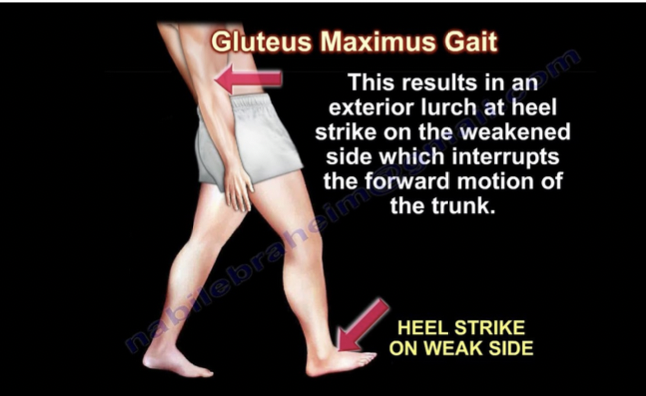 <p>uneven pelvic tilt, person appears to be leaning backwards while walking (center of gravity off), weakness on gluteus maximus, heel strikes ground on weaker side </p>