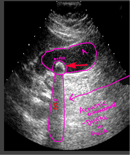 <p>A structure that blocks the sound wave causes acoustic shadowing (gallstones)</p><p>Strongly attenuating or highly reflective surface, the returning echoes posterior to the structure are decreased in amplitude</p>