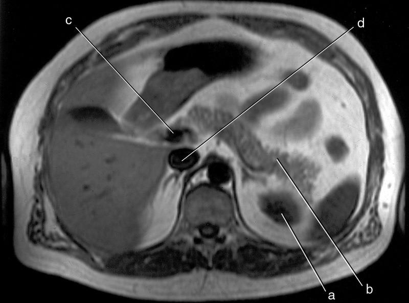 <p><span>Inferior Vena Cava</span></p>