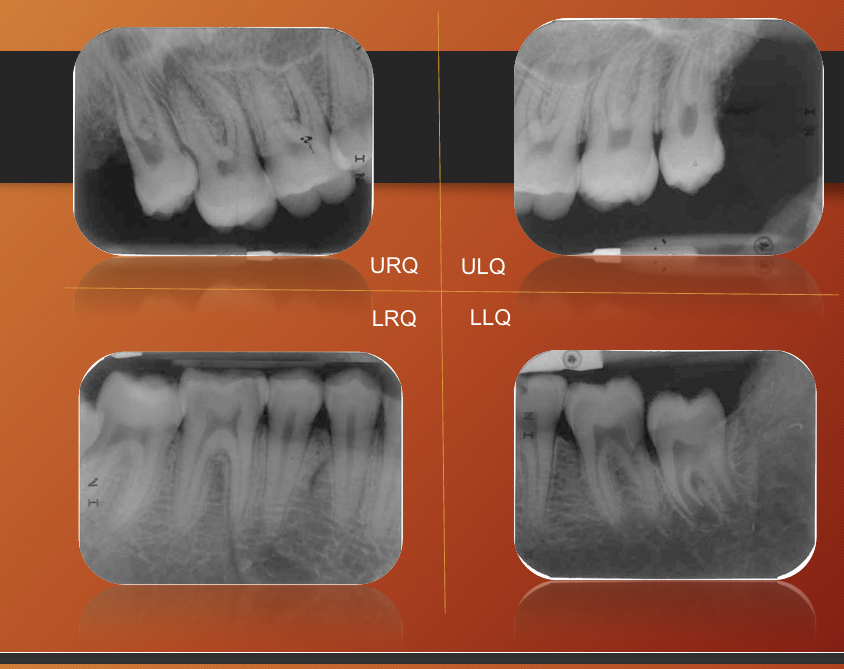 <p>4 periapical better than one panoramic </p>