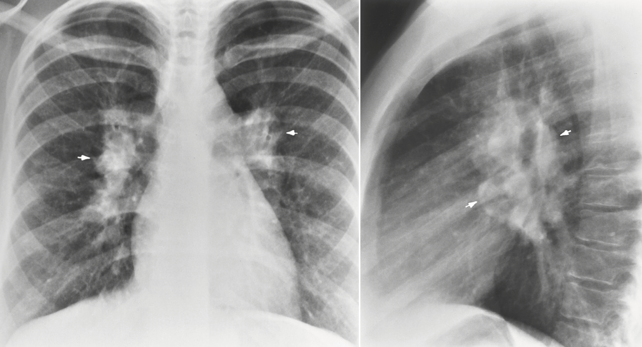 <p>why is Infectious Mononucleosis called “kissing disease”?</p>