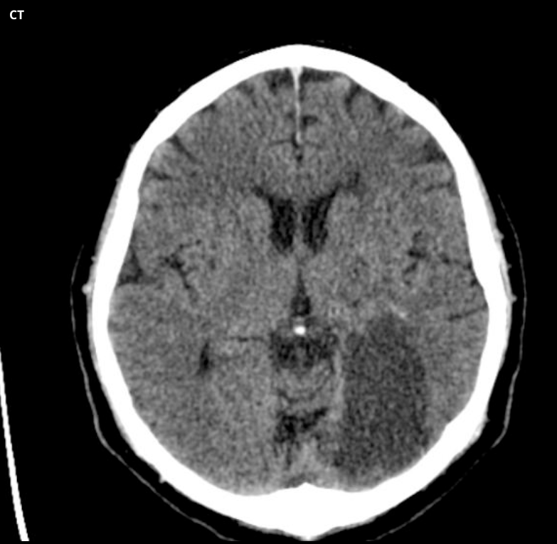 <p>This ischaemic stroke has been caused by blockage of what artery?</p>