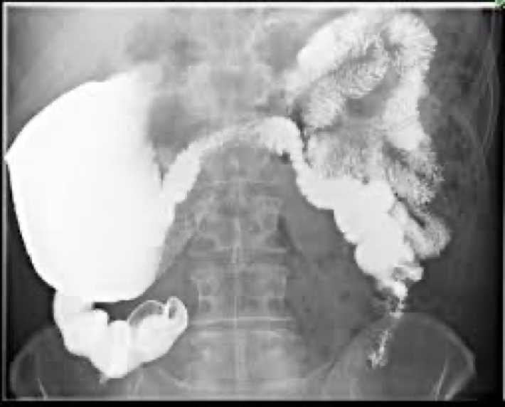<p>Twisting of the bowel on itself causing obstruction</p><p>Mostly cecum or sigmoid</p>