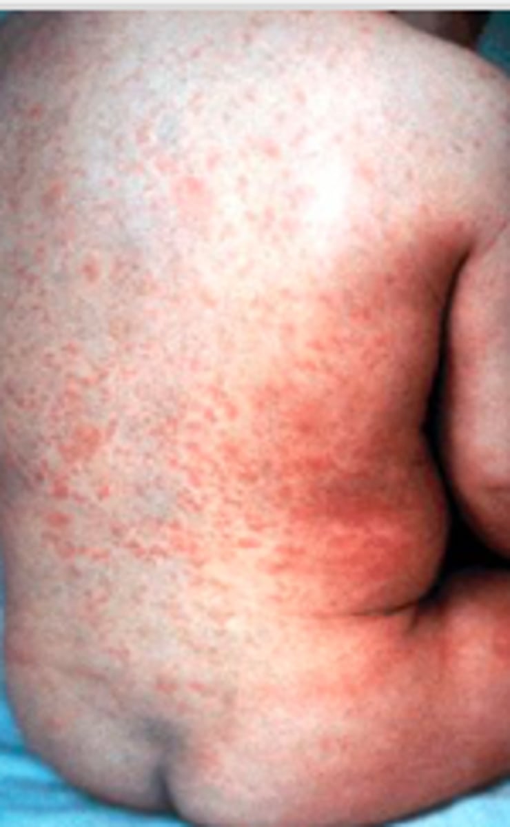 <p>Exanthems:</p><p>Overview:</p><p>- Vaccine-preventable viral illness</p><p>- Self-limiting illness in children, but can have devastating effects on fetus when acquired during pregnancy</p><p>- “German measles” </p><p>- Acquired via close &amp; prolonged contact with infected individuals via inhalation of infectious large particle aerosols</p><p>14-18 day incubation period</p>