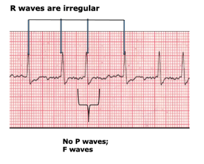 <p>atrial fibrillation </p>