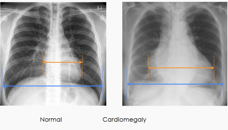<p><span style="color: rgb(255, 255, 255);"><span>The cardiothoracic ratio (CTR) aids in the detection</span></span><span style="color: rgb(255, 255, 255);"><br></span><span style="color: rgb(255, 255, 255);"><span>of enlargement of the cardiac silhouette (most often cardiomegaly but ALSO pericardial effusion)</span></span></p>