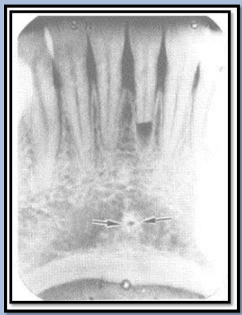 <ul><li><p>Radiopaque</p></li><li><p>Ex. Genial tubercles </p></li></ul><p></p>