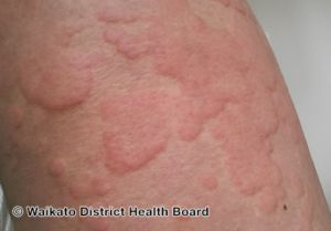 <p>A <strong>wheal</strong> is a <strong>raised, swollen, well-defined area on the skin</strong>, usually as a result of a bug bite.</p>