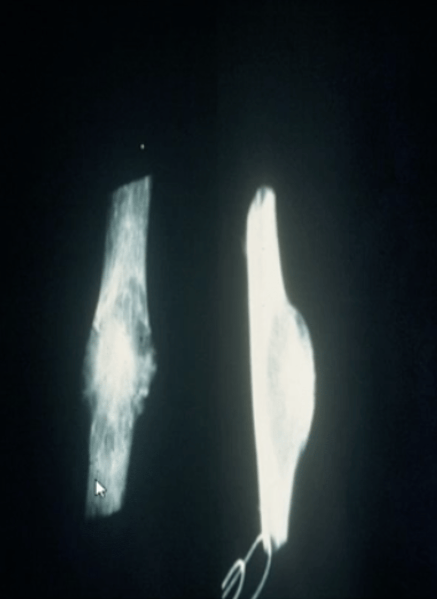 <p>Nidus</p><p>- radioopaque in the center</p><p>- radioluscent in the periphery</p>