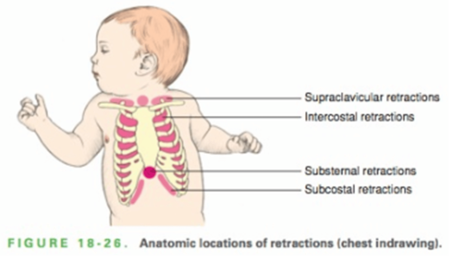 <p>the thorax is more rounded in infants than in older children and adults </p><p>assess RR, breathing pattern and color of child </p><p>assess component of breathing- flaring nares</p><p>listen for audible breath sounds and work of breathing</p>