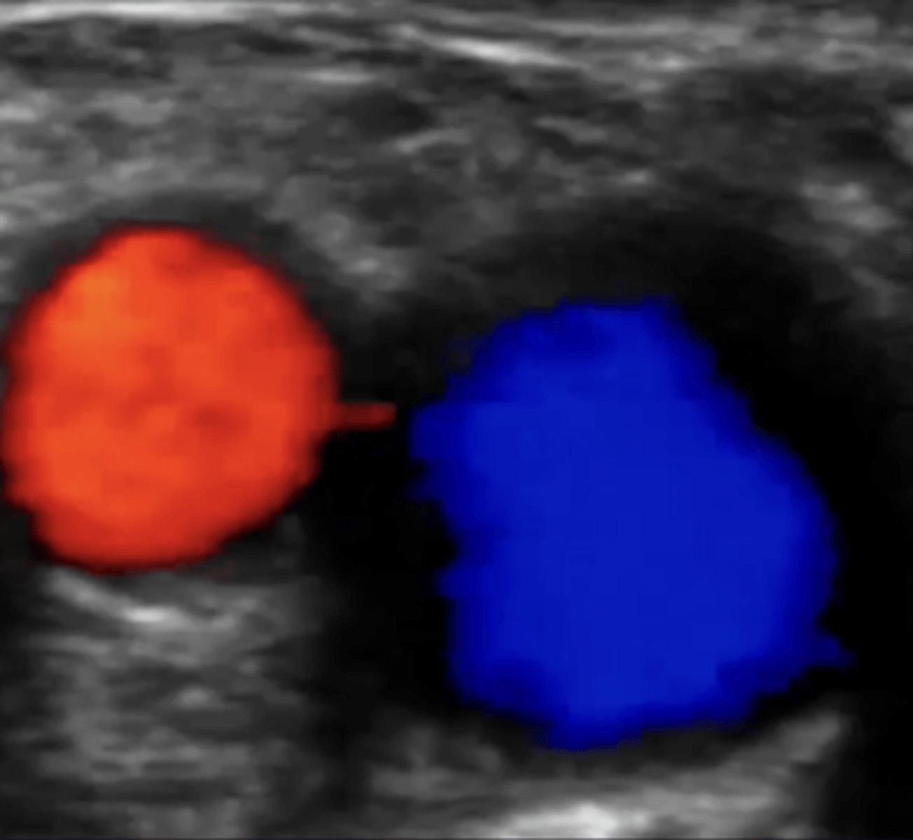 <p>on doppler, which describes a red vessel?</p>