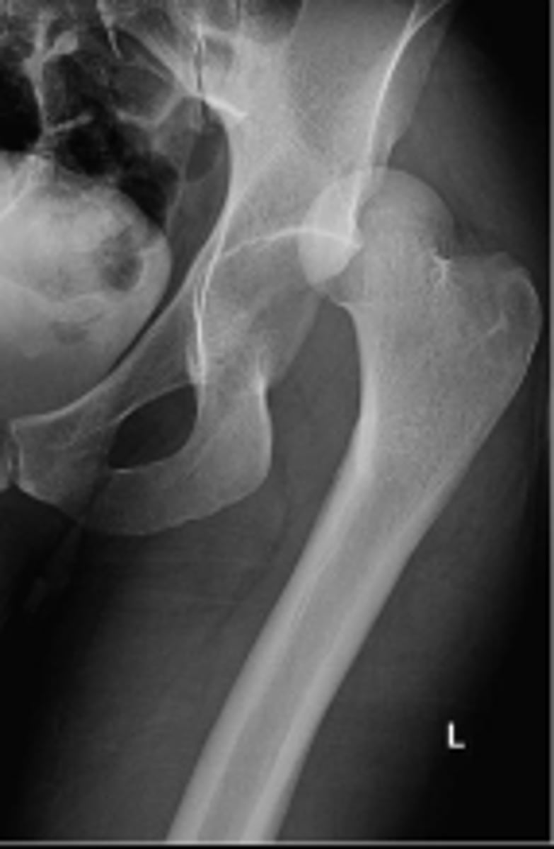 <p>What is most significant radiographic finding?</p>