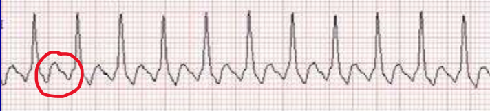 <p>What rhythm is present on the ECG below?</p>