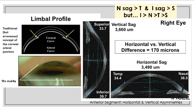 <ul><li><p>Traditional concept shows smooth corneal–scleral junction, but reality shows an angled transition</p></li><li><p>Horizontal vs vertical asymmetry is significant</p><ul><li><p>Vertical sag ≈ 3,660 µm</p></li><li><p>Horizontal sag ≈ 3,490 µm</p></li><li><p>Difference ≈ 170 µm</p></li></ul></li><li><p>Sectoral sag pattern: <strong>Inferior &gt; Nasal &gt; Temporal &gt; Superior</strong></p></li><li><p>Overall rule shown: <strong>N sag &gt; T &amp; I sag &gt; S</strong>, but full order = <strong>I &gt; N &gt; T &gt; S</strong></p></li><li><p>Limbal profile reveals true asymmetry important for scleral lens fitting</p></li></ul><p></p>