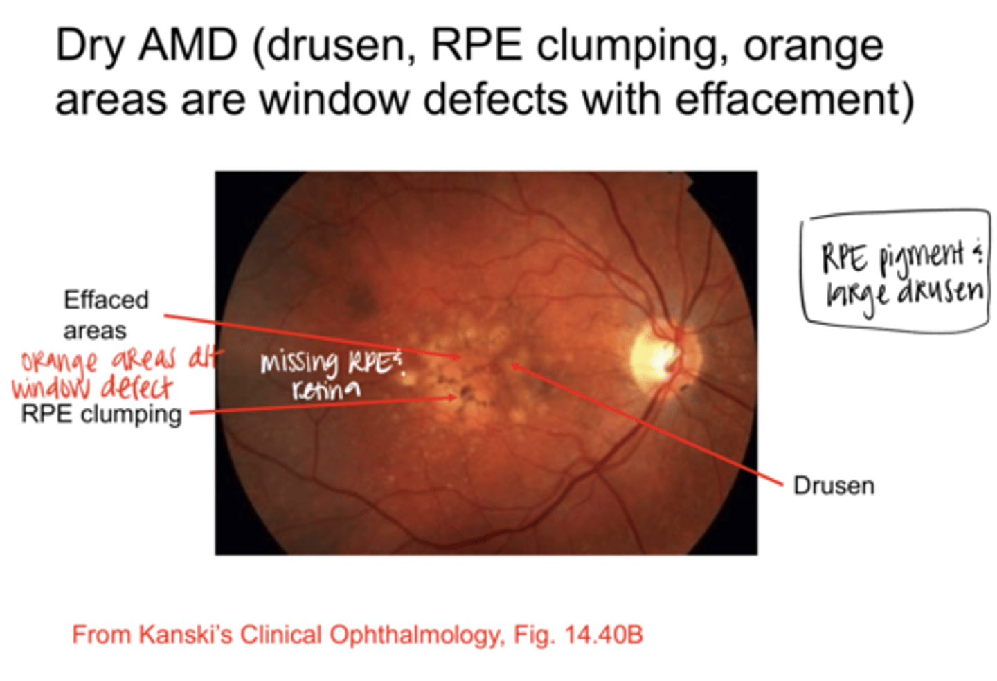 <p>Dry AMD -- Drusen, RPE Clumping, Orange Areas are Window Defects with Effacement (Pic)</p>