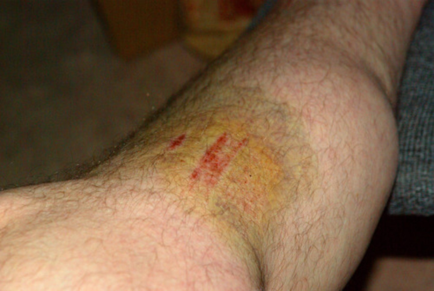 <p>A bruise. A subcutaneous collection of blood.</p>