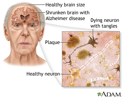 <p></p><ul><li><p>Most common type of dementia</p></li><li><p>Brain cell connections and the cells themselves degenerate and die, eventually destroying memory and other important mental functions.</p></li><li><p>Progressive, starts with mild memory loss leading to loss of the ability to follow a conversation or interact with environment</p></li><li><p>Memory loss and confusion are the main symptoms.<br></p><ul><li><p>forget about recent conversations or events</p></li><li><p>misplace items</p></li><li><p>forget the names of places and objects</p></li><li><p>have trouble thinking of the right word</p></li><li><p>ask questions repetitively.</p></li><li><p>show poor judgement or find it harder to make decisions</p></li><li><p>become less flexible and more hesitant to try new things</p></li></ul></li></ul>