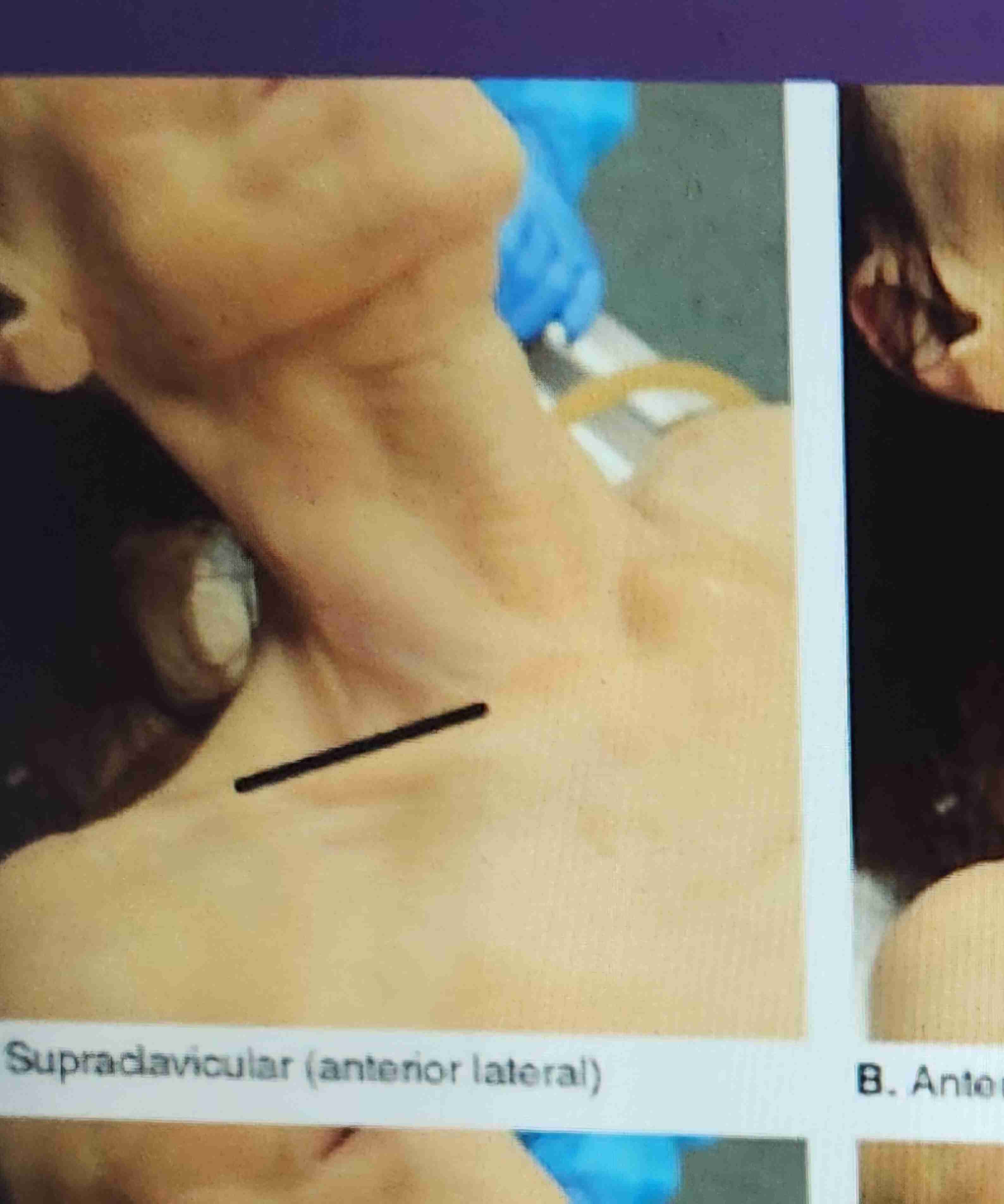<p>supraclavicular incisions</p>