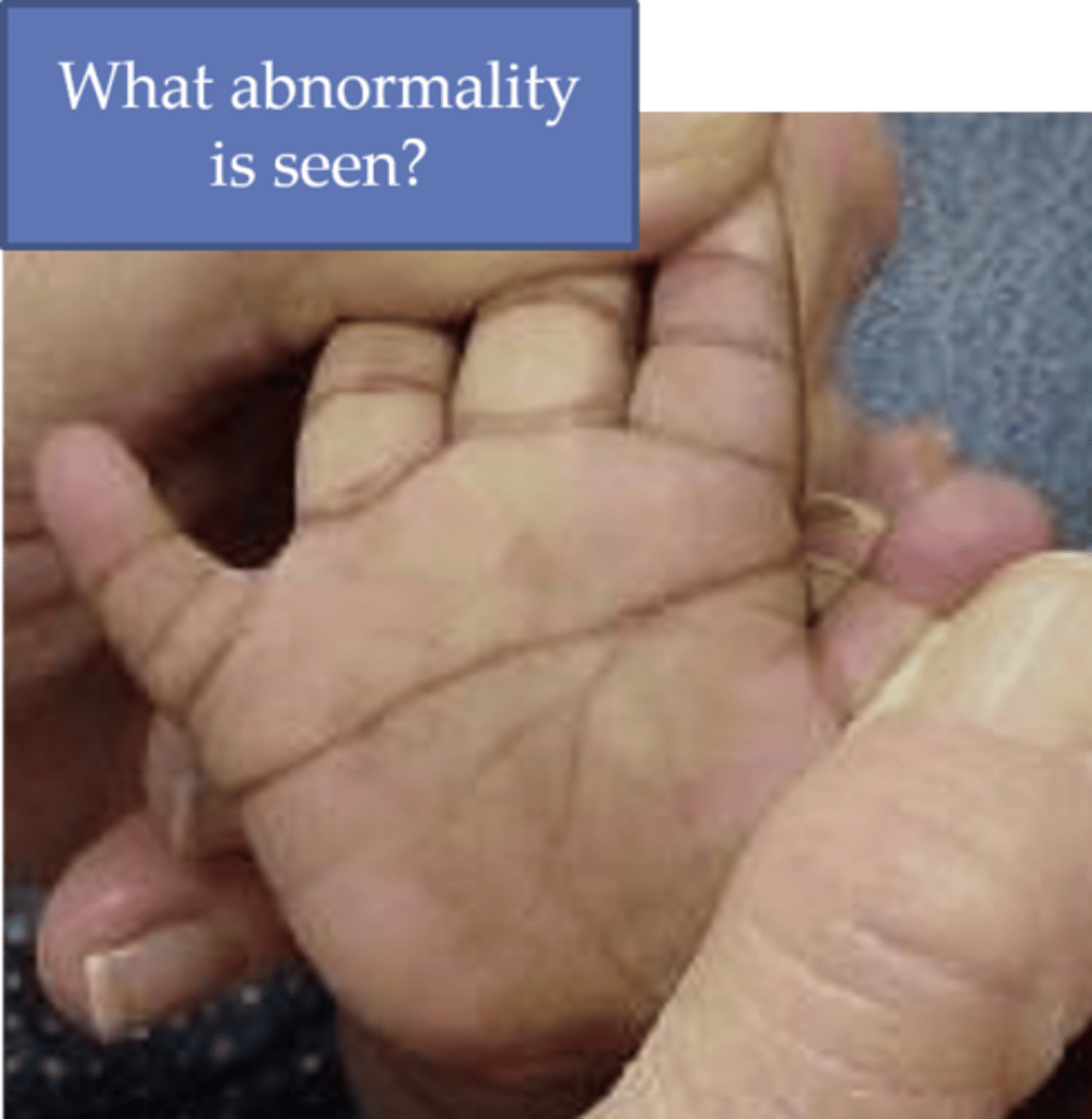 <p>Down syndrome (trisomy 21), VSD &gt; 50%</p>