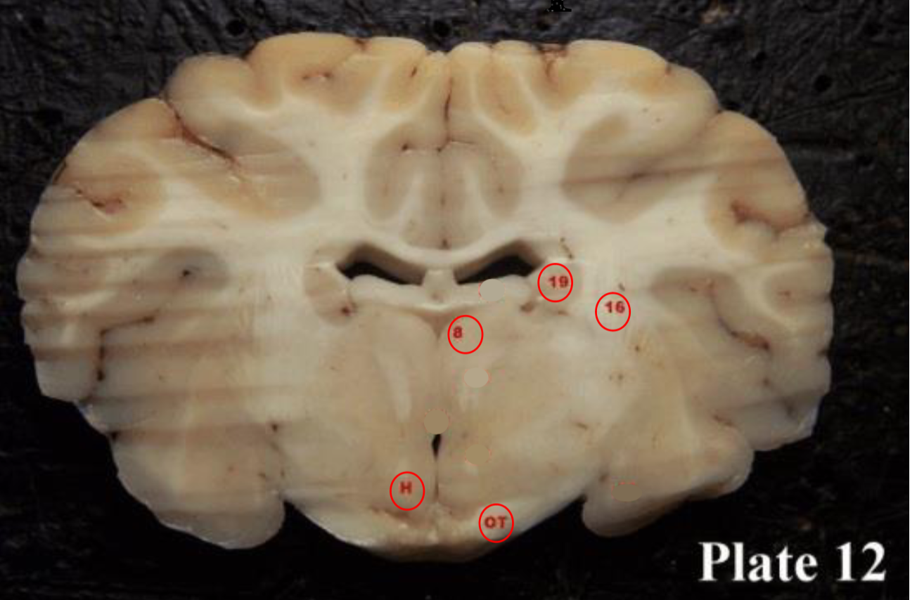 <p>(OT) are part of the visual system in the brain and<br>are the posterior continuation of the optic nerves after the medial (temporal lobe) fibers decussate at the optic chiasm.</p>
