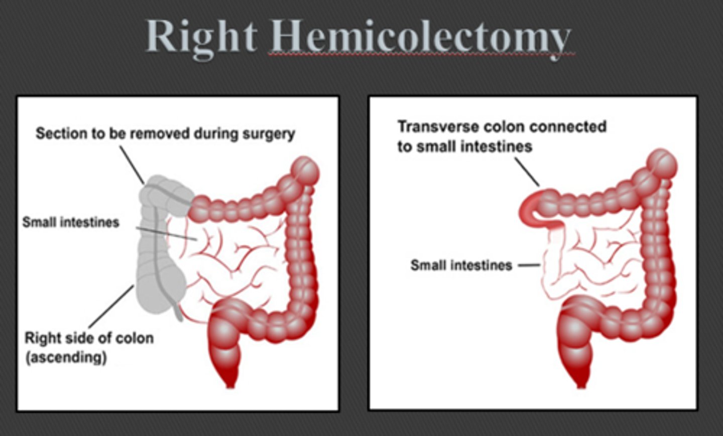<p>(hem-ee-koh-LECK-tuh-mee) the surgical removal of half of the colon. (ការកាត់ពោះវៀនធំផ្នែកខាង)</p>