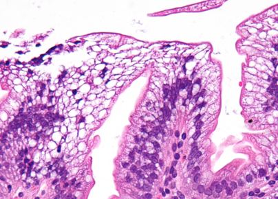<p><span>The enterocytes or simple columnar epithelium cells have an accumulation of fluid and increased cytoplasm. Enterocytes’ function is to assist with absorption. In an individual with Abetalipoproteinemia, the enterocytes cannot function appropriately due to this fluid accumulation, and, therefore, cannot absorb nutrients appropriately.&nbsp;</span></p>