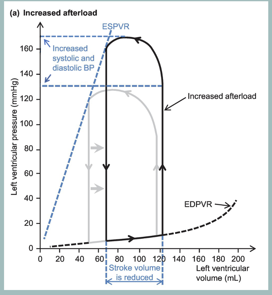 <ul><li><p><span>an increase in afterload (rightward shift of the left limb). </span></p></li><li><p><span>obstruction causes a large pressure gradient to occur during ejection such that end-systolic pressure in the ventricle is greatly increased.&nbsp;</span></p><ul><li><p><span>The impairment in left ventricular emptying results in an increase in end-systolic volume and a decrease in stroke volume. </span></p></li><li><p><span>Note that the shift in the loop will cause a dramatic increase in the internal work (potential energy) due to the energy spent increasing left ventricular pressure prior to ejection of blood</span></p></li></ul></li><li><p>Mild increase in end-diastolic volume due to excess volume from increased end-systolic volume</p></li><li><p>Chronic HCM leads to decreased compliance/increase in slope of EDPVR + end-diastolic pressure</p></li></ul><p></p>