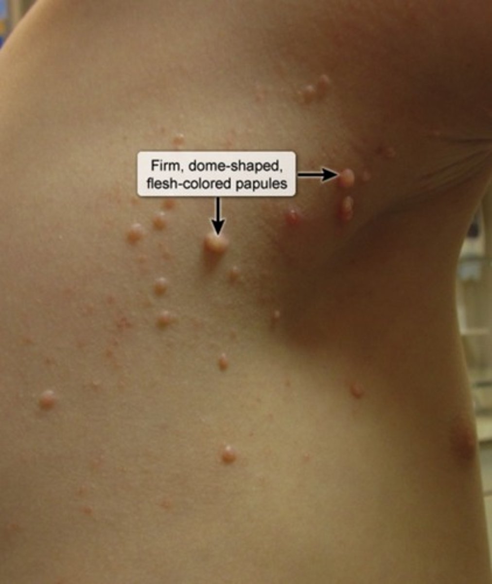 <p>dsDNA virus</p><p>-Linear genome</p><p>-Enveloped</p><p>Sx</p><p>-Molluscum Contagiosum (Firm + Dom-shaped papules w/ central indentation)</p>