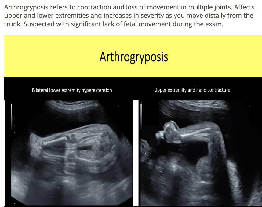 <p>c) bilateral talipes, deformed elbows, wrists, ankles, knees, and hips</p>