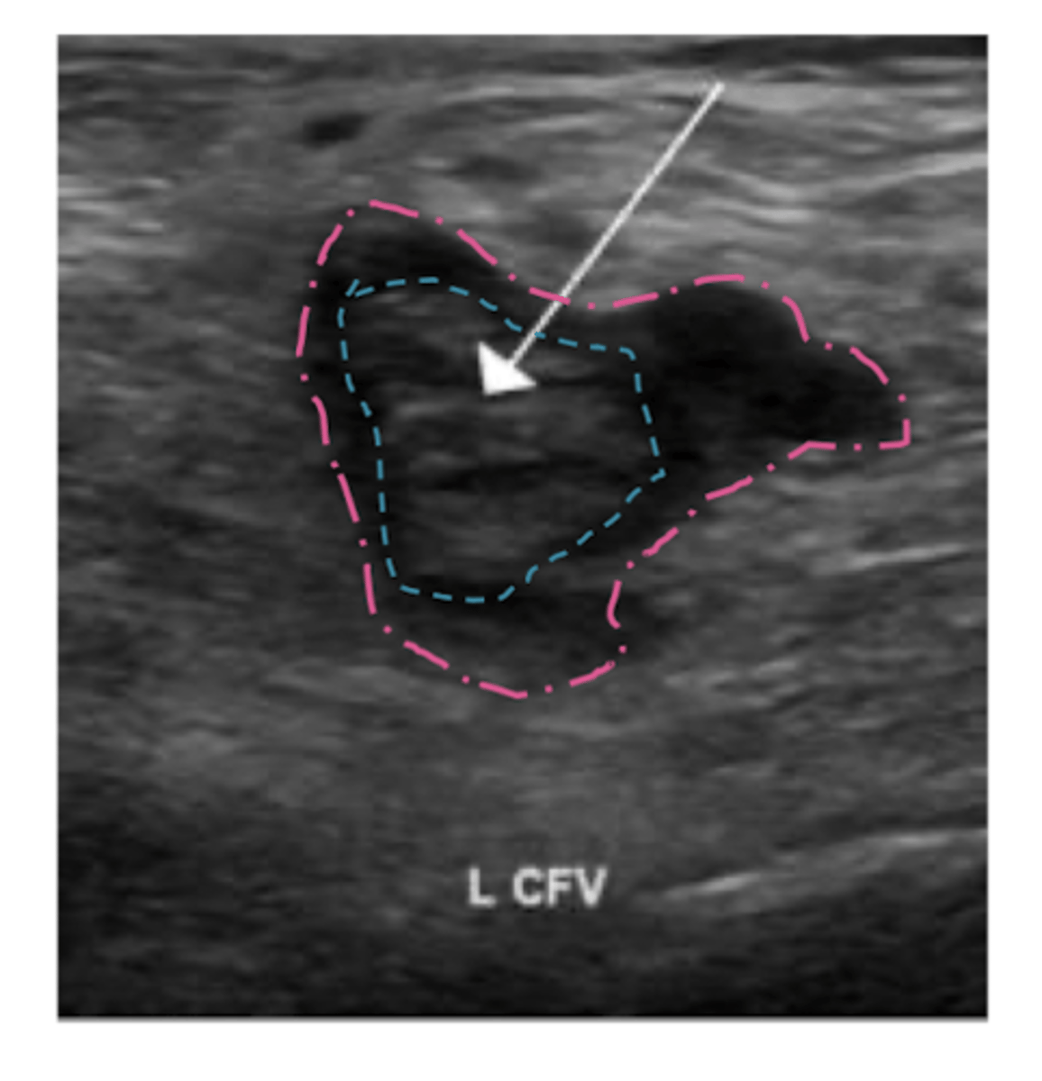 <p>duplex u/s of inguinal region, thigh, and popliteal area</p><p>second line: contrast venogram</p>