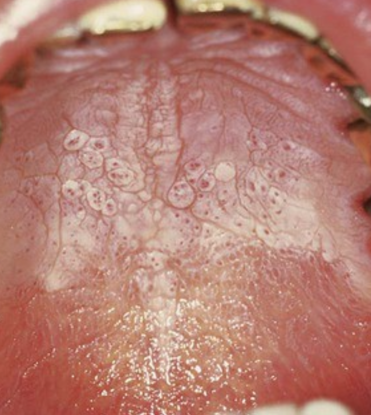 <p>What does nicotine stomatitis look like clinically?</p>